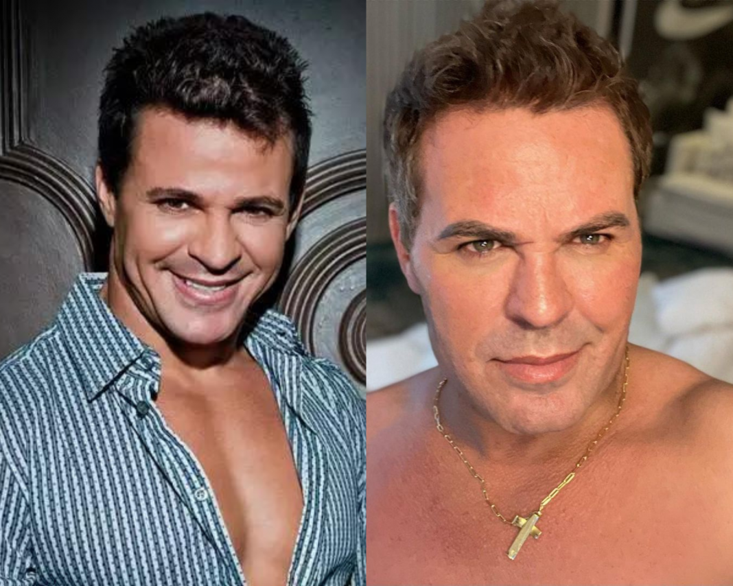 Veja O Antes E Depois De Famosos Que Fizeram Harmoniza O Facial Paipee