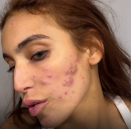 Recentemente, ela foi franca e falou abertamente sobre suas dificuldades com a acne. (Foto: Reprodução)