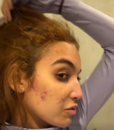 Ela continuou: “Estou enfrentando esse problema com a acne e passei por várias outras dificuldades ao longo do ano, que todos puderam acompanhar". (Foto: Reprodução)