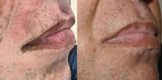 Um industrial de 54 anos, que enfrentava o vitiligo em quase todo o corpo, relatou uma mudança radical após as atualizações. (Foto: Divulgação)