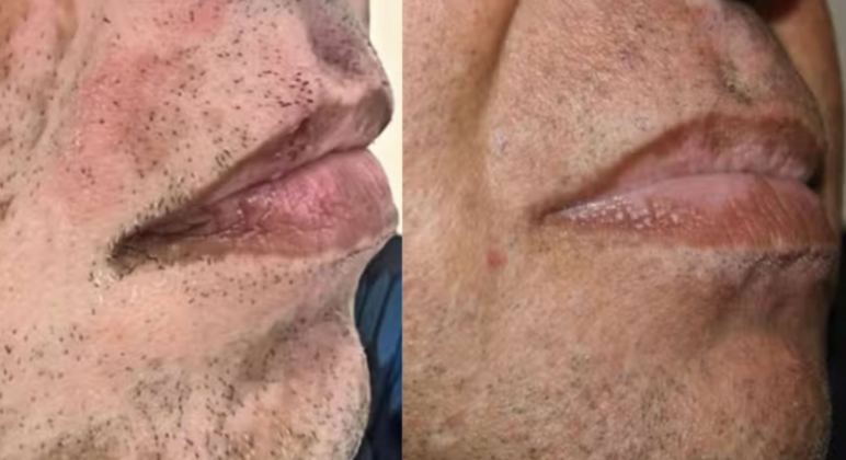 Um industrial de 54 anos, que enfrentava o vitiligo em quase todo o corpo, relatou uma mudança radical após as atualizações. (Foto: Divulgação)