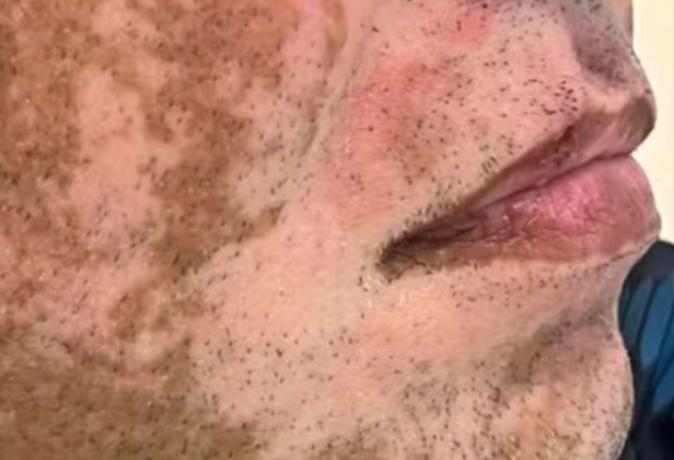 De acordo com o dermatologista Paulo Luzio, responsável pelo tratamento, 93% do pigmento da pele do homem retornou após o fim do casamento, indicando que a condição estava ligada a fatores emocionais. (Foto: Divulgação)