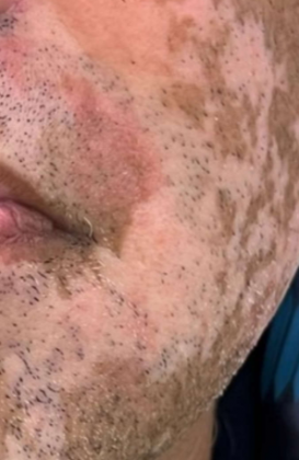 “O casamento tinha, hoje eu sei, traços de toxicidade”, afirmou o homem ao G1, relatando o impacto do relacionamento na saúde da pele. Ele explicou que a ansiedade e o nervosismo desencadeados durante o casamento agravaram as manchas. (Foto: Divulgação)