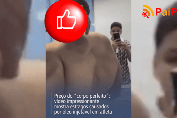 Preço do “corpo perfeito”: vídeo impressionante mostra estragos causados por óleo injetável em atleta
