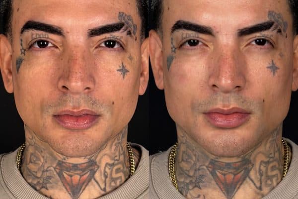 Onda Vini Jr.? MC Guimê choca ao revelar harmonização facial
