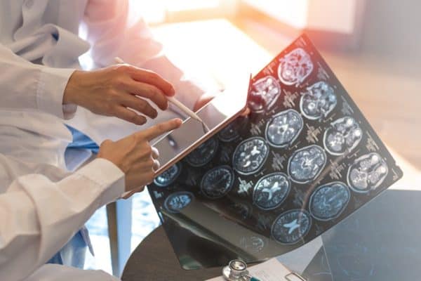 SUS disponibiliza nova medicação para pacientes com ELA em fase inicial