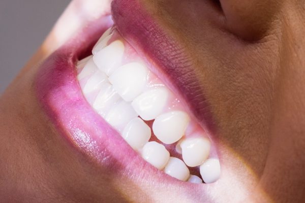 Estudo liga inflamação gengival à calcificação de válvula cardíaca