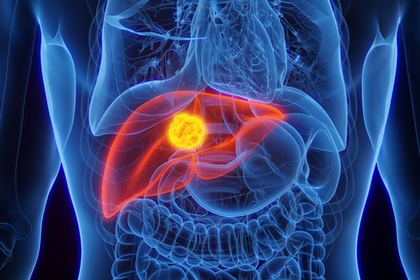 Novo exame de DNA da UCLA pode detectar câncer e doenças hepáticas precocemente