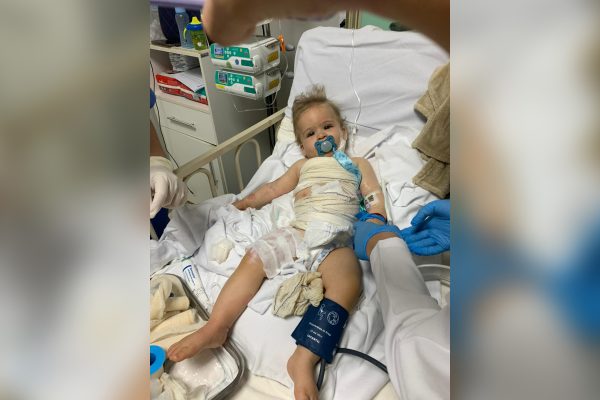 Bebê de 9 meses se recupera de queimaduras graves após acidente doméstico em Brasília
