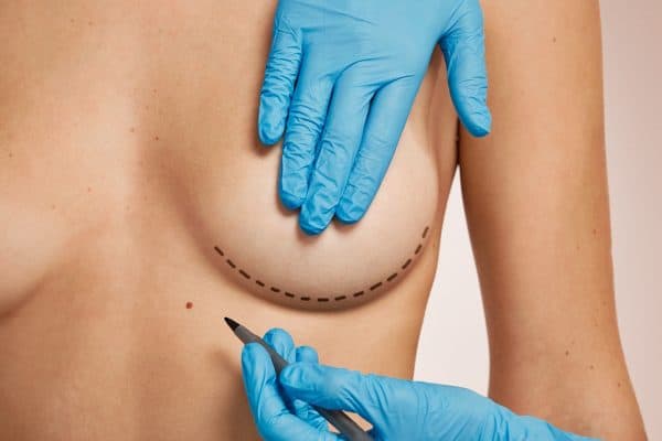 Silicone: Respeitar o Tempo de Recuperação Evita Deslocamento Durante o Sexo