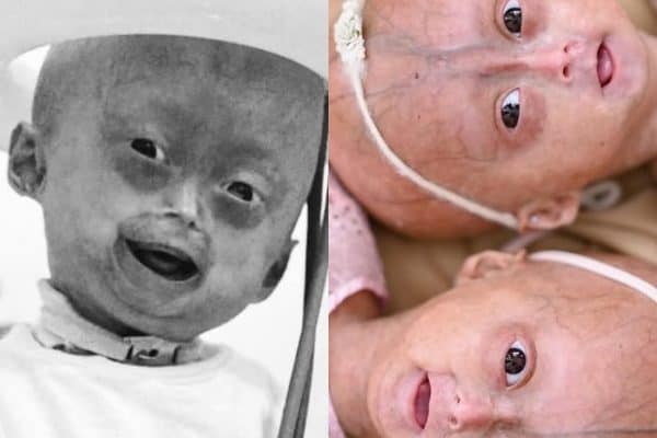 Elis, Influencer Mirim com Síndrome Rara, Morre aos 5 Anos