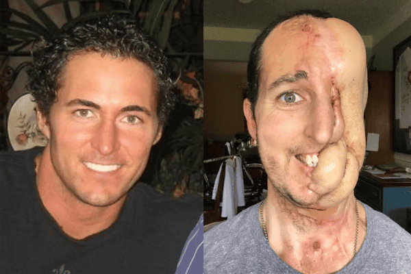 Homem surpreende com impressionante reconstrução facial após grave doença