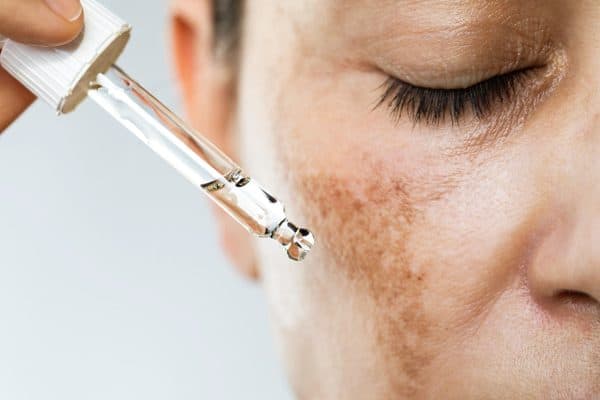 Dermatologista Regina Buffman explica os três tipos de melasma e seus tratamentos